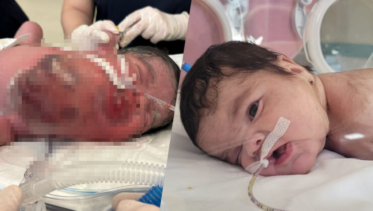 Minik Eymen’in daha doğmadan hayat mücadelesi başladı: 439 gram tümör çıkarıldı